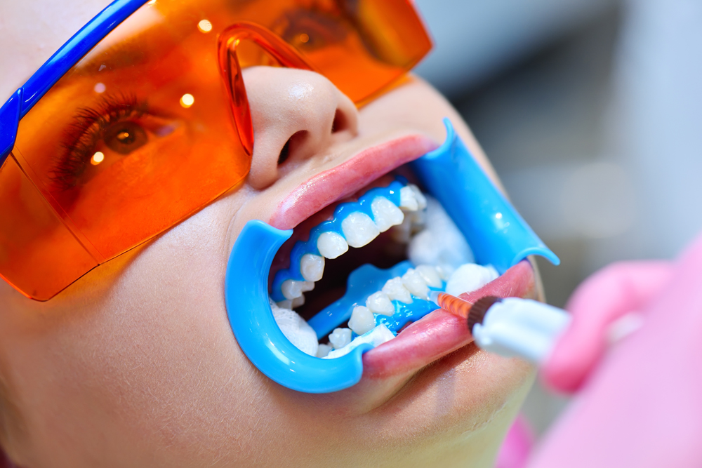 Was beim Frisör funktioniert, funktioniert auch beim Zahnarzt 1 Dentist applies gel to teeth before teeth whitening procedure. Beautiful girl in safety glasses. Dental And Teeth Whitening Concept, Stichwort Zahnarzt.
(c) AdobeStock